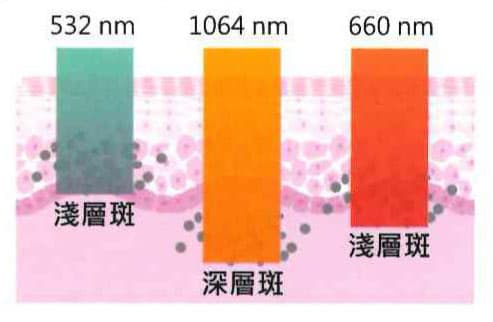 除斑術 除斑術