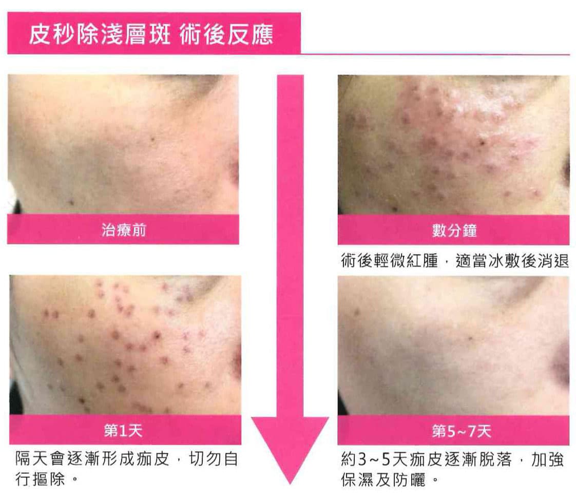 除斑術 除斑術