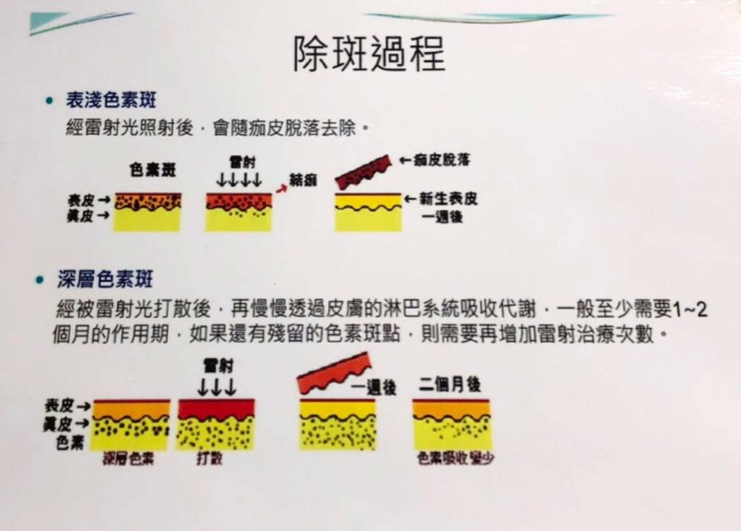 C6淨膚雷射 C6淨膚雷射