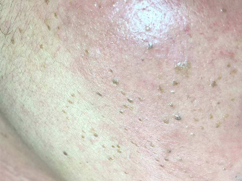 點痣|點疣(高震波電流)