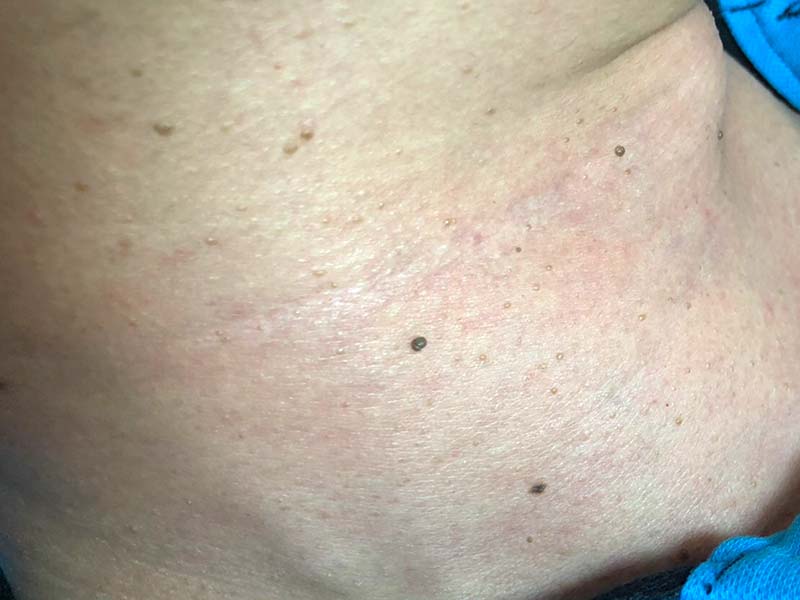 點痣|點疣(高震波電流)