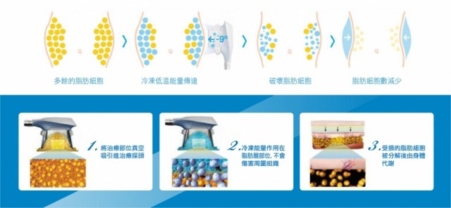 鑽石冰雕低溫減脂 鑽石冰雕低溫減脂