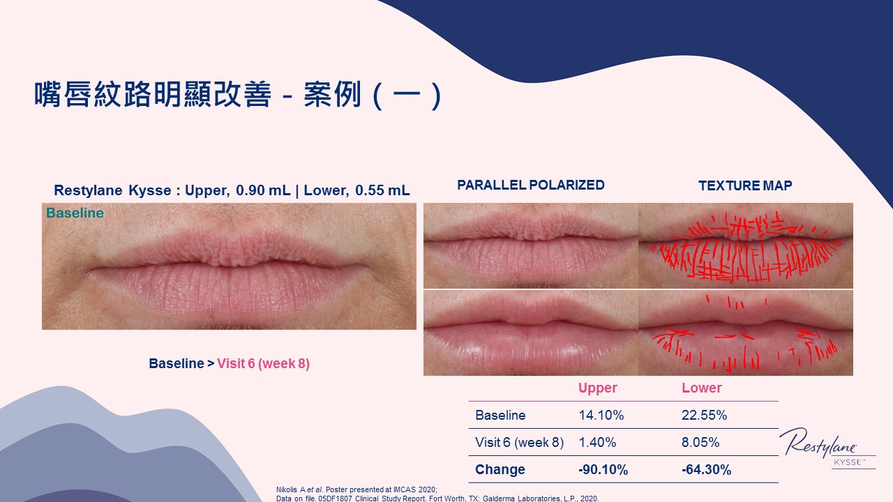 女神Kysse-漾唇K劑型