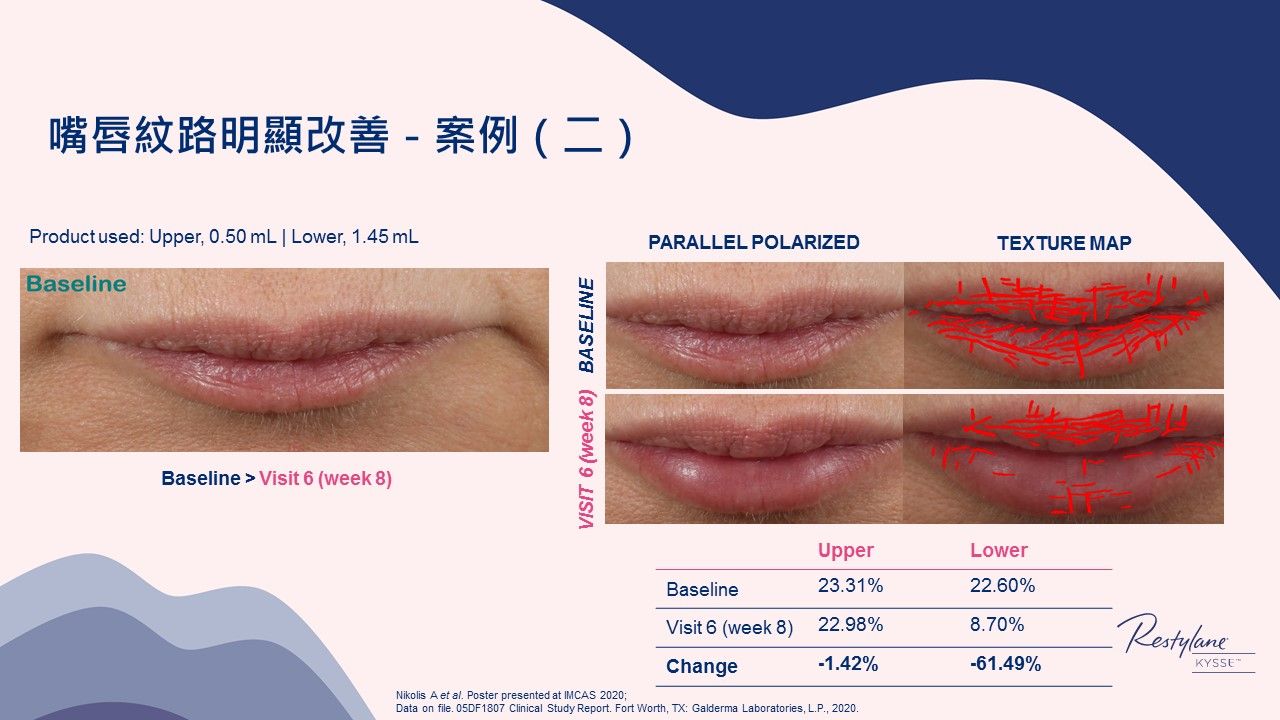 女神Kysse-漾唇K劑型