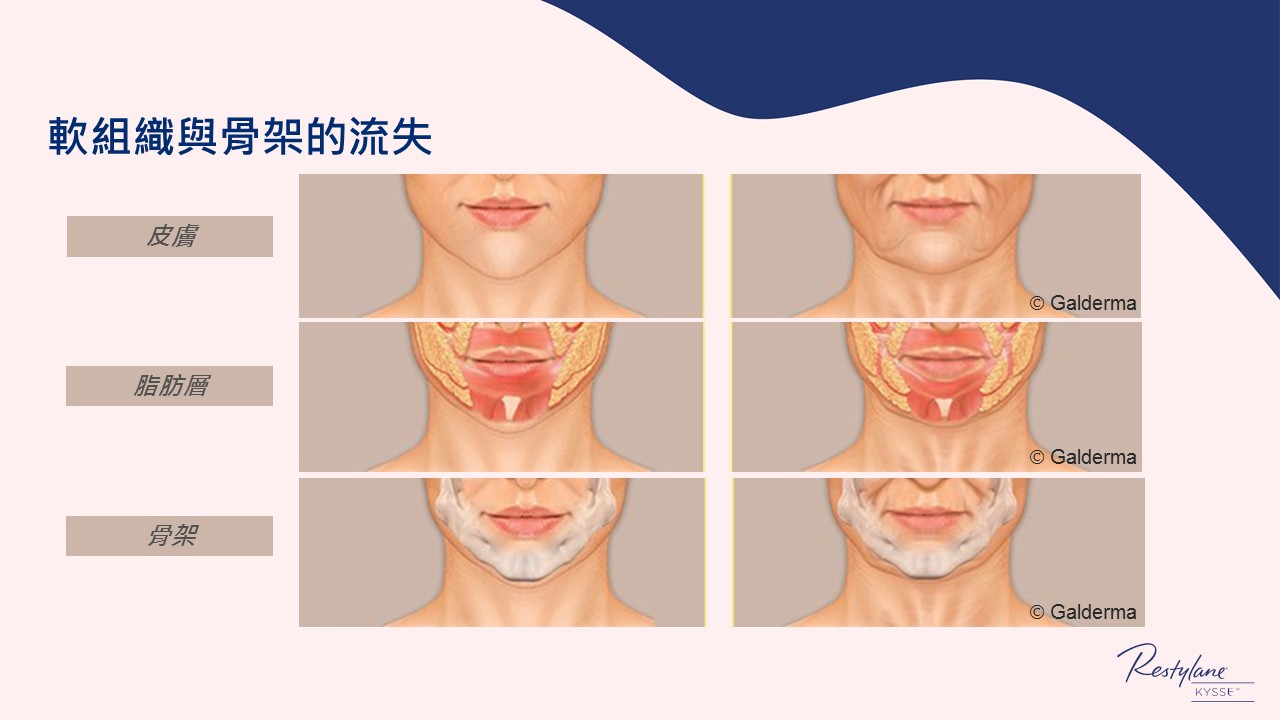 女神Kysse-漾唇K劑型