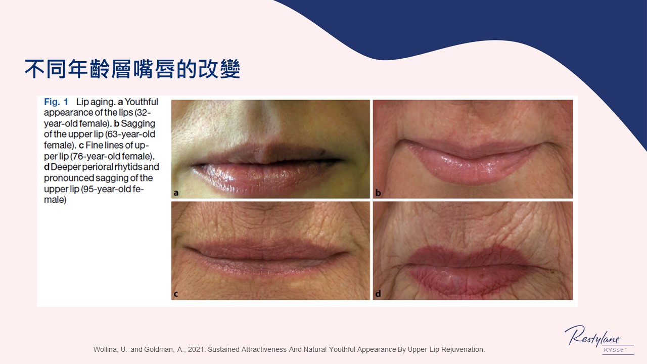 女神Kysse-漾唇K劑型