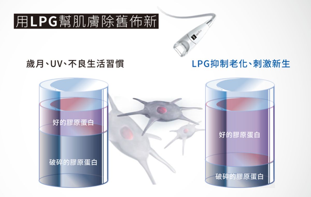 LPG Cellu M6 Alliance 第十代法式纖體雕塑 LPG Cellu M6 Alliance 第十代法式纖體雕塑