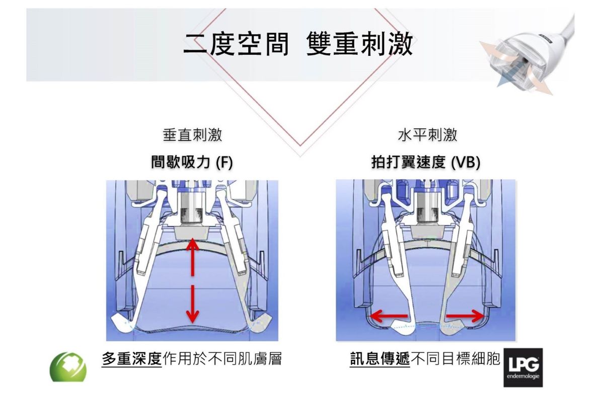 LPG Cellu M6 Alliance 第十代法式纖體雕塑 LPG Cellu M6 Alliance 第十代法式纖體雕塑