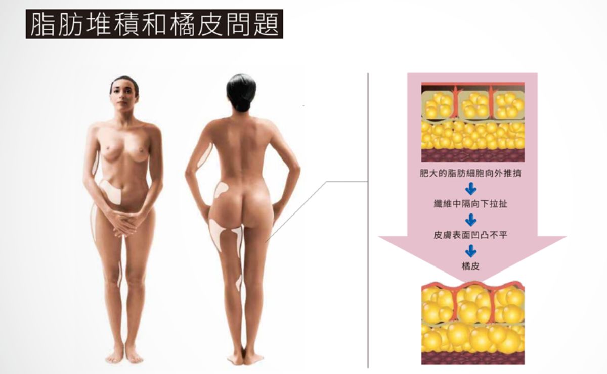 LPG Cellu M6 Alliance 第十代法式纖體雕塑 LPG Cellu M6 Alliance 第十代法式纖體雕塑
