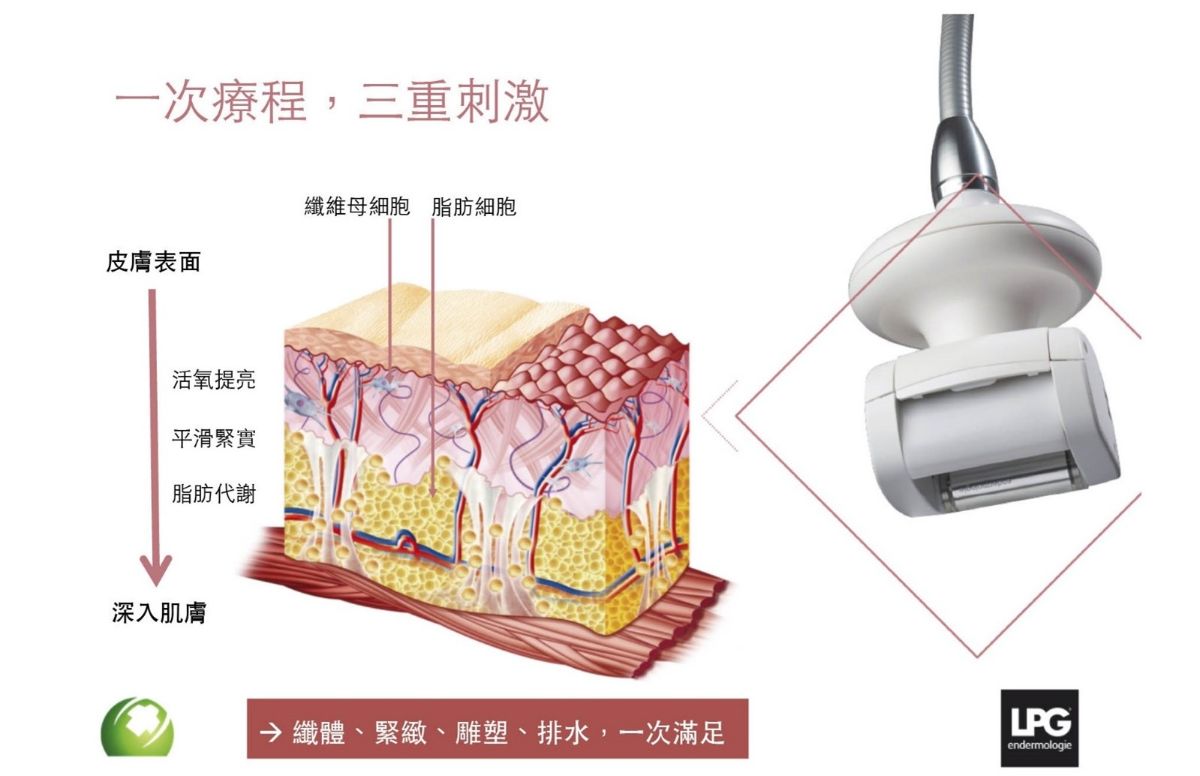 LPG Cellu M6 Alliance 第十代法式纖體雕塑 LPG Cellu M6 Alliance 第十代法式纖體雕塑