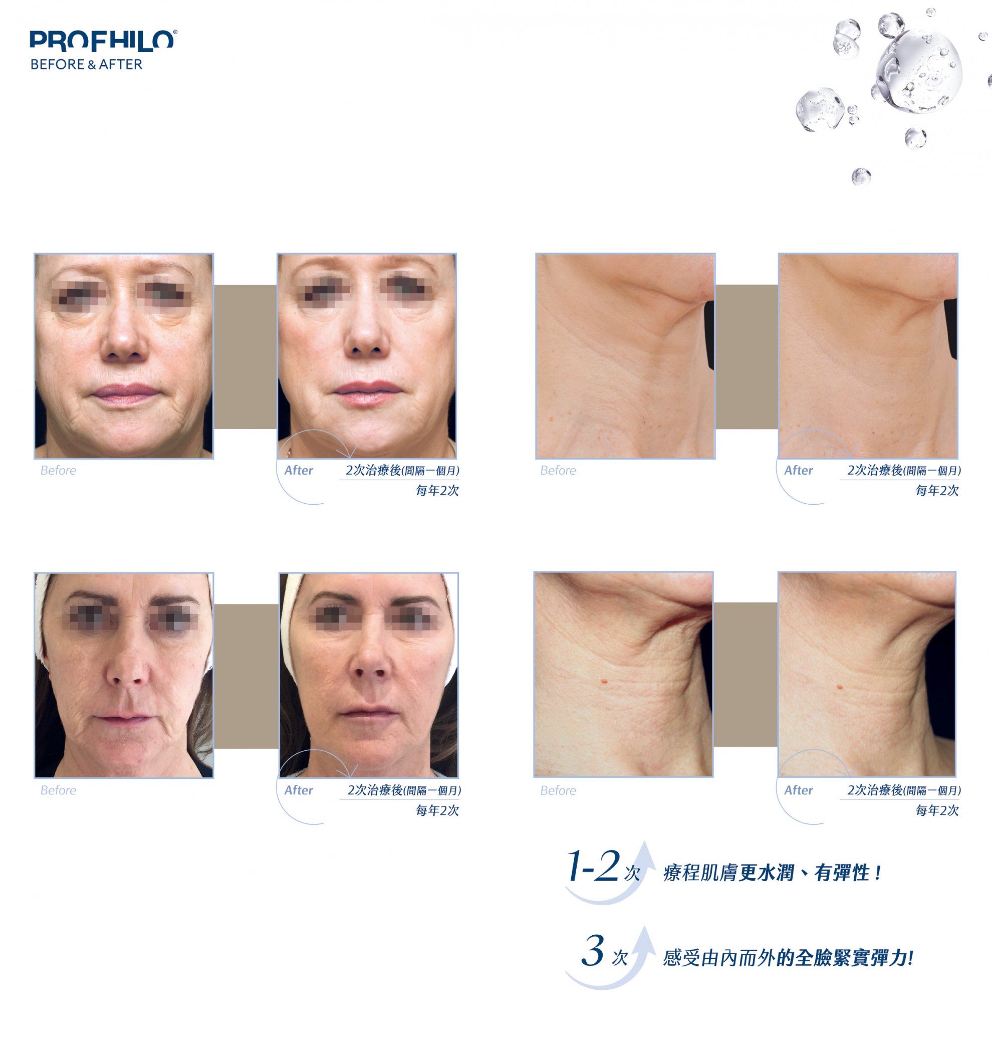【生物重塑新美學】PROFHILO 逆時針：從肌底啟動 膠原蛋白與彈力蛋白的再生能力